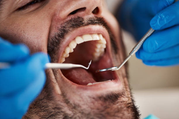 Best Emergency Tooth Extraction in Boiling Springs, PA